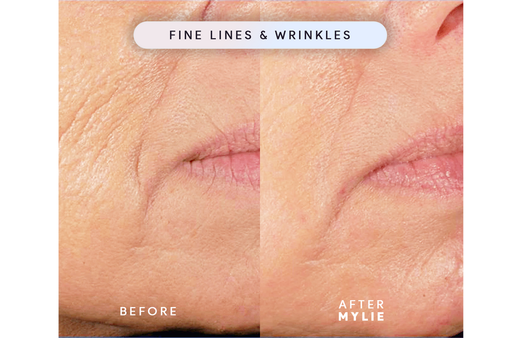 My Facial Plump - Anti-Aging Serum