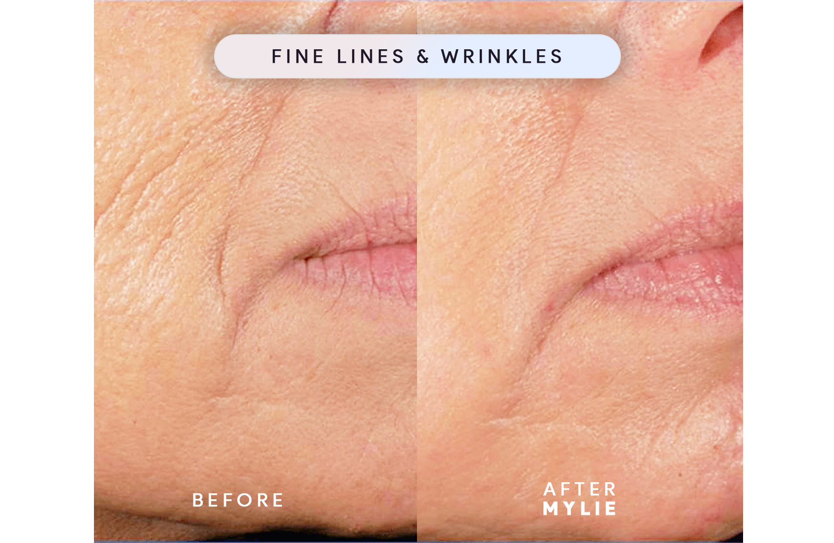 My Facial Plump - Anti-Aging Serum