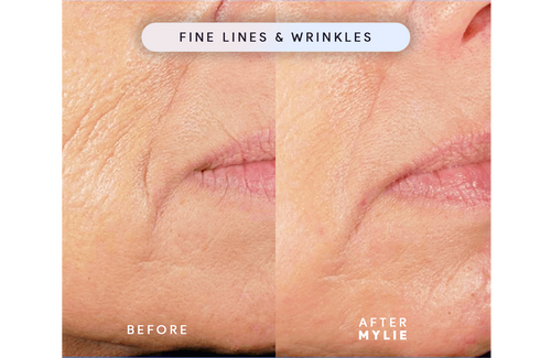 My Facial Plump - Anti-Aging Serum