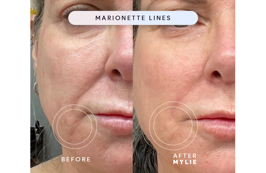 My Facial Plump - Anti-Aging Serum