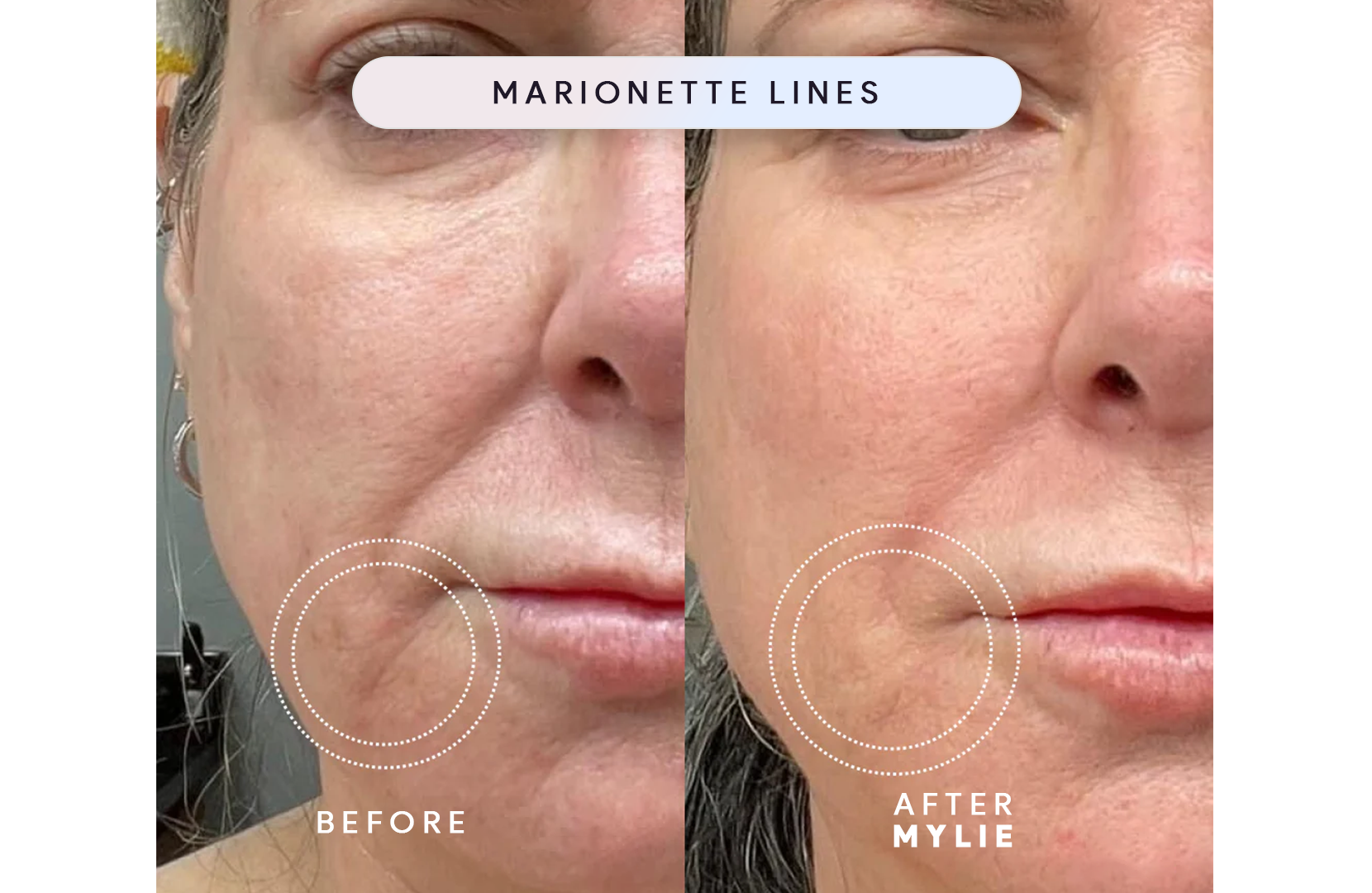 My Facial Plump - Anti-Aging Serum