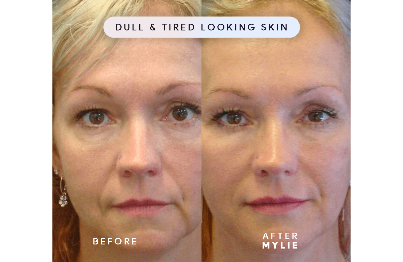 My Facial Plump - Anti-Aging Serum